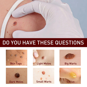 Pomada Caneta para Verrugas Ke Warts, Removedor de Mole Preto, Reparação da Pele, Clareamento, Cuidado Hidratante, 3ml