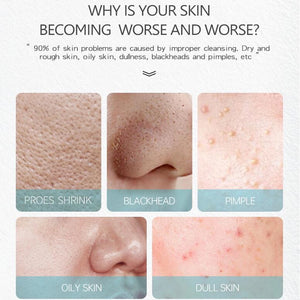 Creme Facial Anti-Acne com Ácido Salicílico para Remover Óleo e Cabeça Preta, Clareador de Cicatrizes