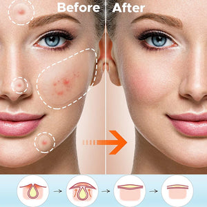 Creme Facial Anti-Acne com Ácido Salicílico para Remover Óleo e Cabeça Preta, Clareador de Cicatrizes