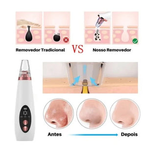 Removedor De Cravos Espinhas Cleaning Sugador Poros Acne Sucção Usb Recarregável
