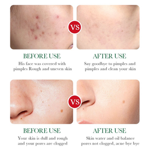 Ácido Salicílico Soro Facial Hidratante e Clareamento para Refinamento de Poros e Anti-rugas