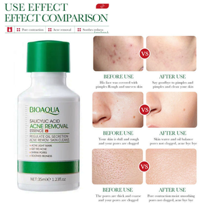 Ácido Salicílico Soro Facial Hidratante e Clareamento para Refinamento de Poros e Anti-rugas