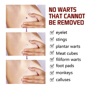 Pomada Caneta para Verrugas Ke Warts, Removedor de Mole Preto, Reparação da Pele, Clareamento, Cuidado Hidratante, 3ml