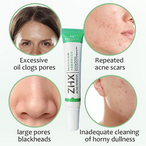 Creme Facial Anti-Acne com Ácido Salicílico para Remover Óleo e Cabeça Preta, Clareador de Cicatrizes